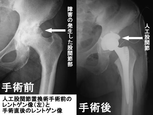 骨盤・股関節の手術